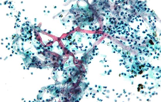Mucorales (Mucormycosis) Mucorales (Mucormycosis)